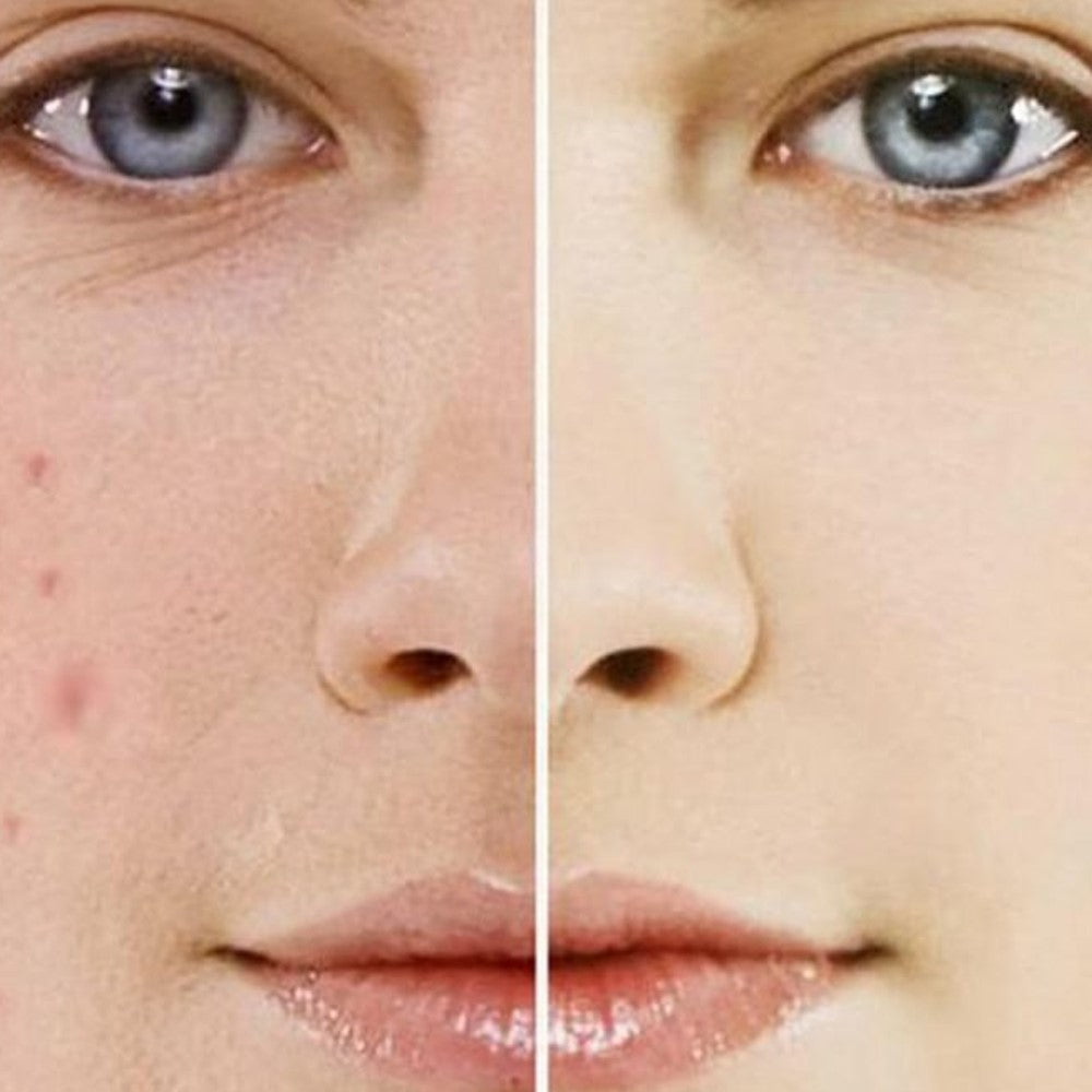 Acne & Pigmentation Treatment
